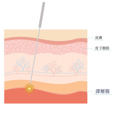 深層筋鍼法のイメージ